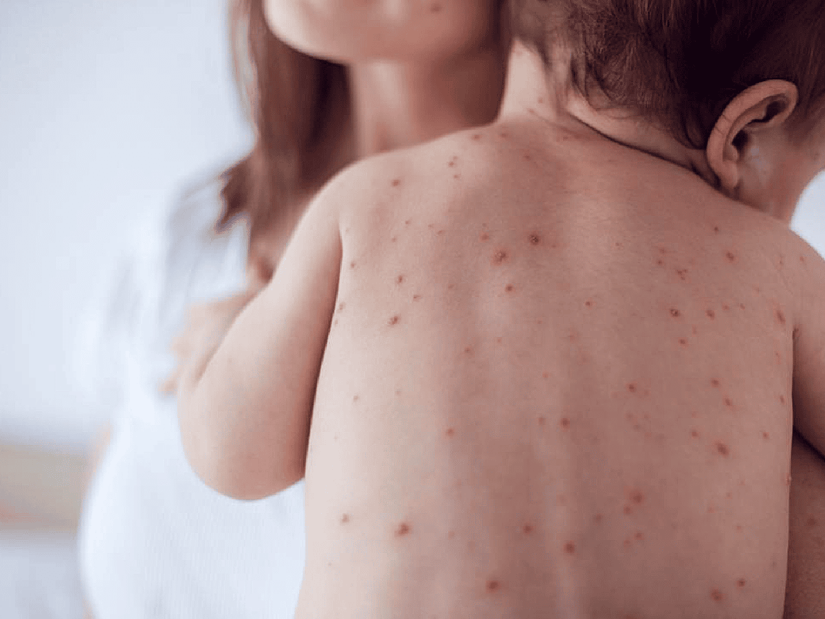 Una mujer "antivacunas" contrajo sarampión y contagió a sus cinco hijos