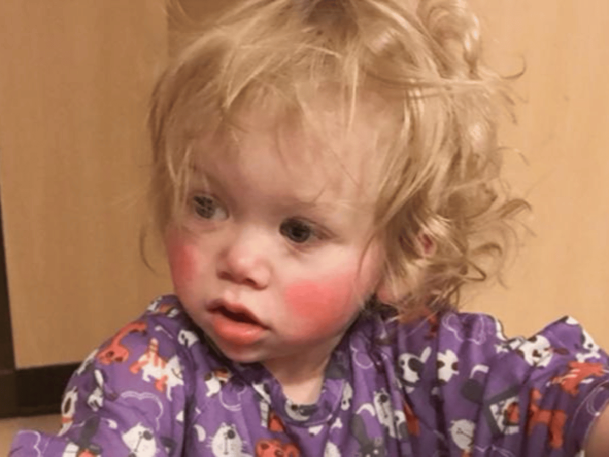 El caso de la nena que no puede llorar ni transpirar por su alergia al agua