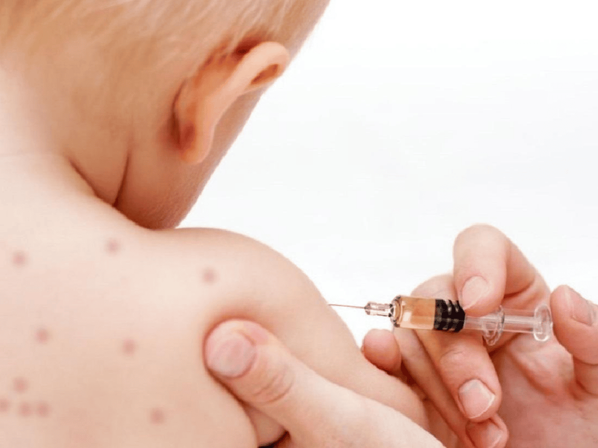 Nuevos casos de sarampión en tres niños no vacunados