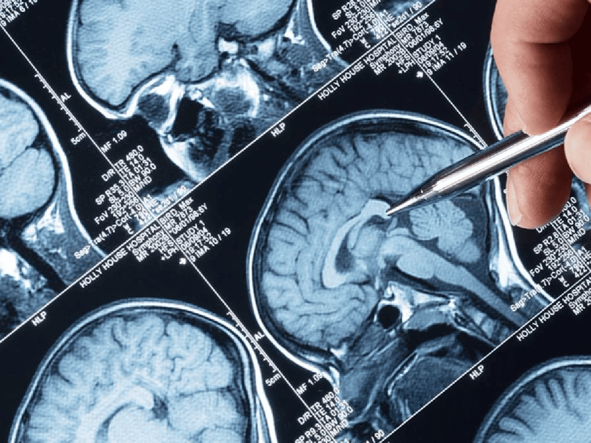 Epilepsia: 10 mitos para derribar