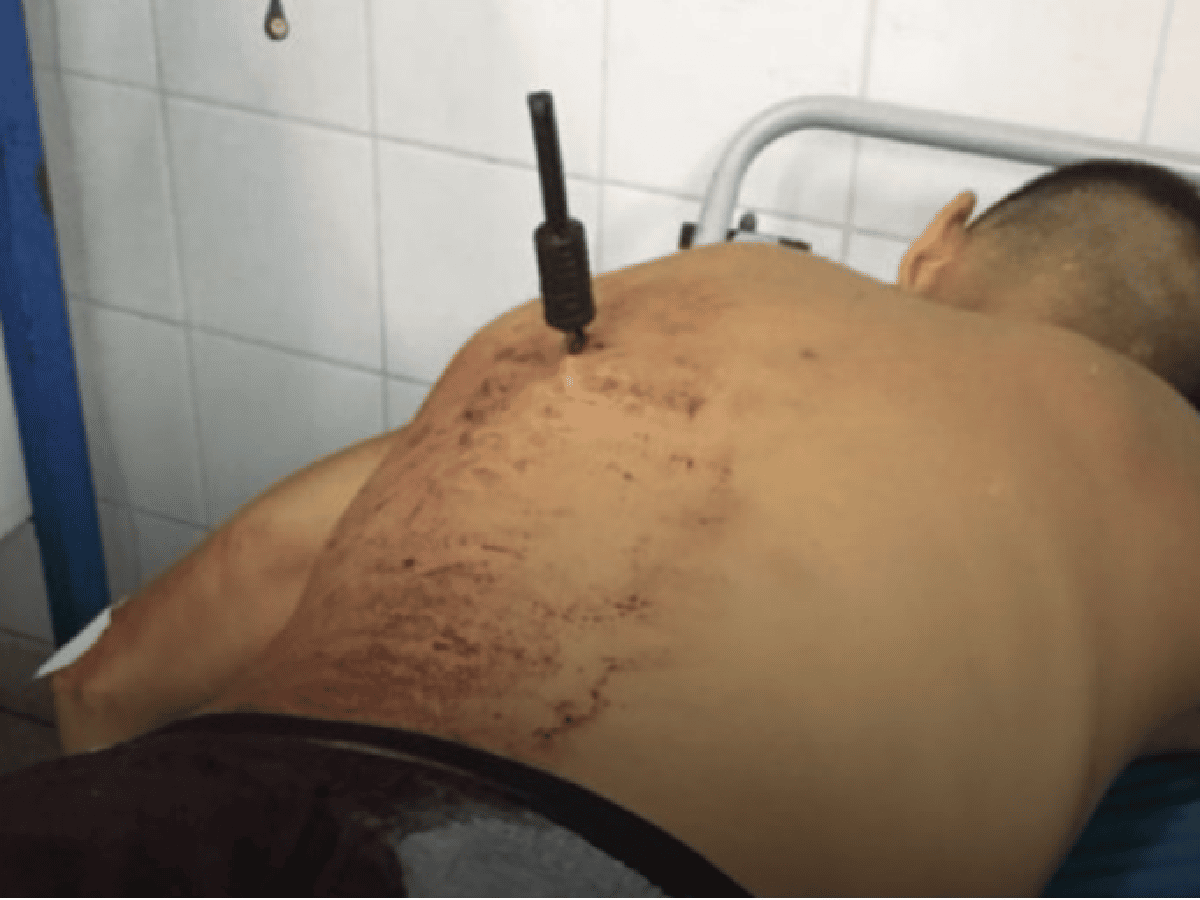 Córdoba: robó, una mujer lo apuñaló en la espalda y terminó internado