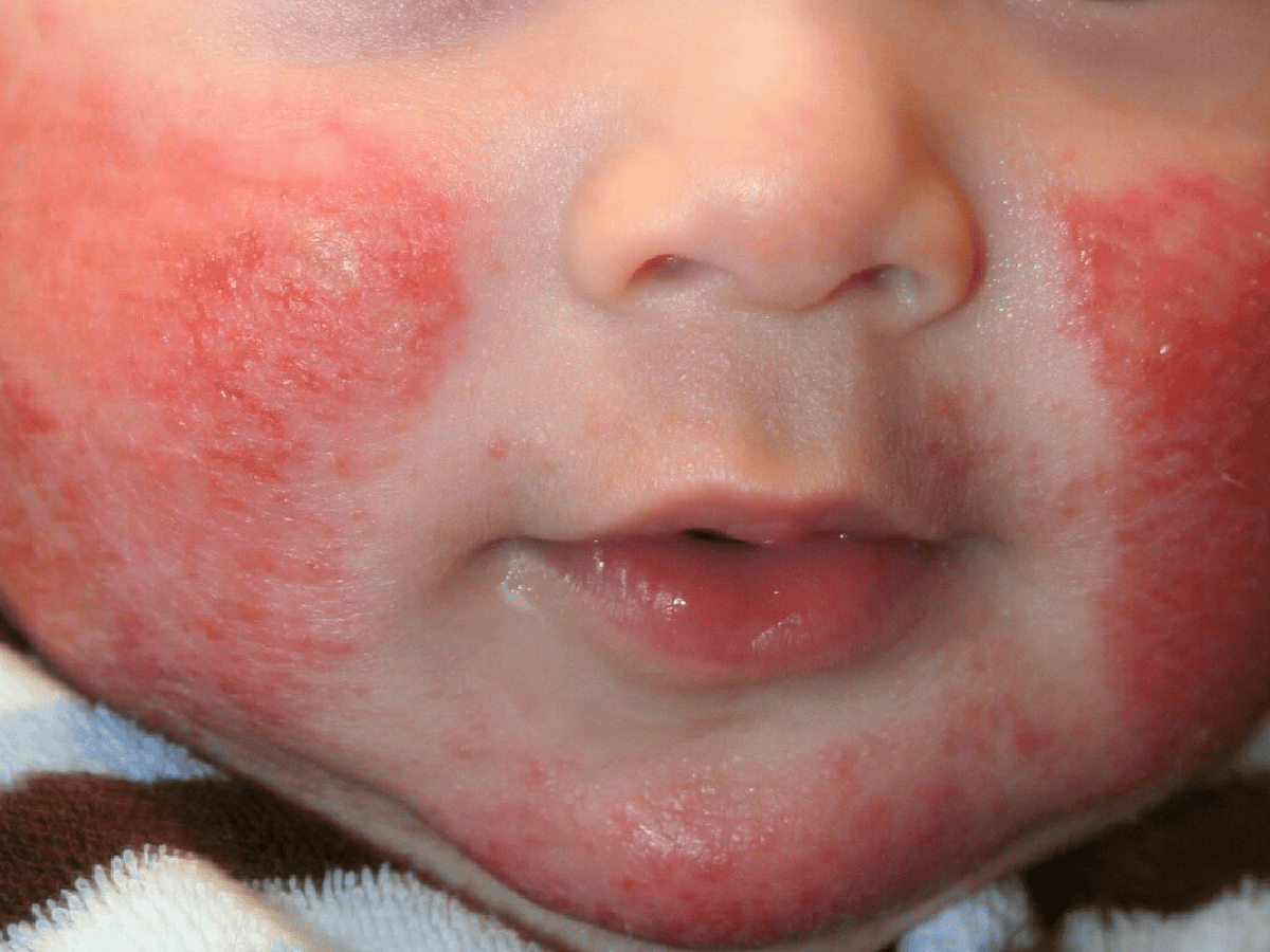 Advierten que la dermatitis atópica empeora con el frío: cuidados