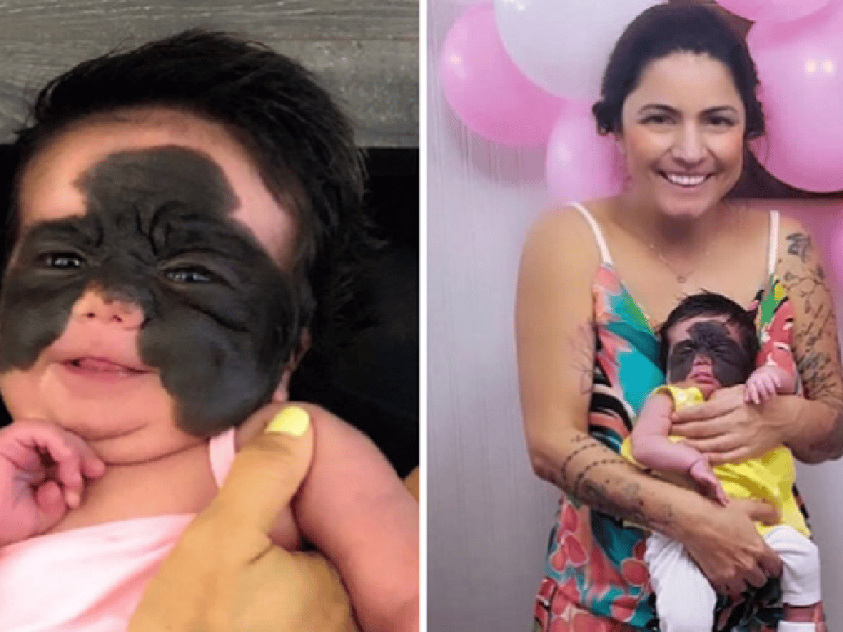 Luna, la beba con una marca de nacimiento en la piel que enfrenta a los haters en las redes sociales