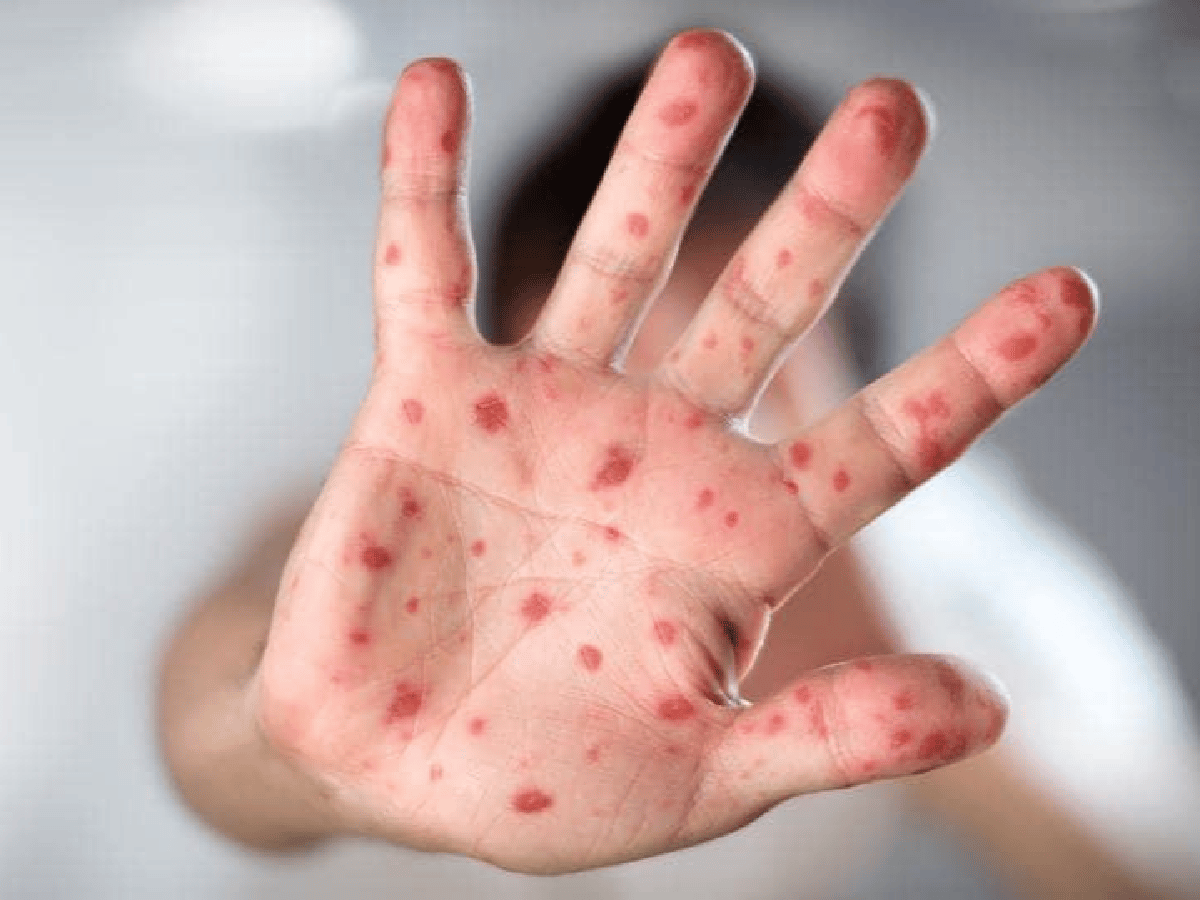 Confirman 35 casos de sarampión: más del doble que el total del año pasado