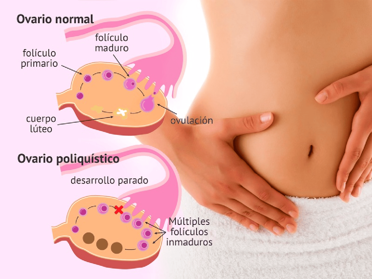 El síndrome de ovario poliquístico: síntomas de una de las causas de infertilidad 