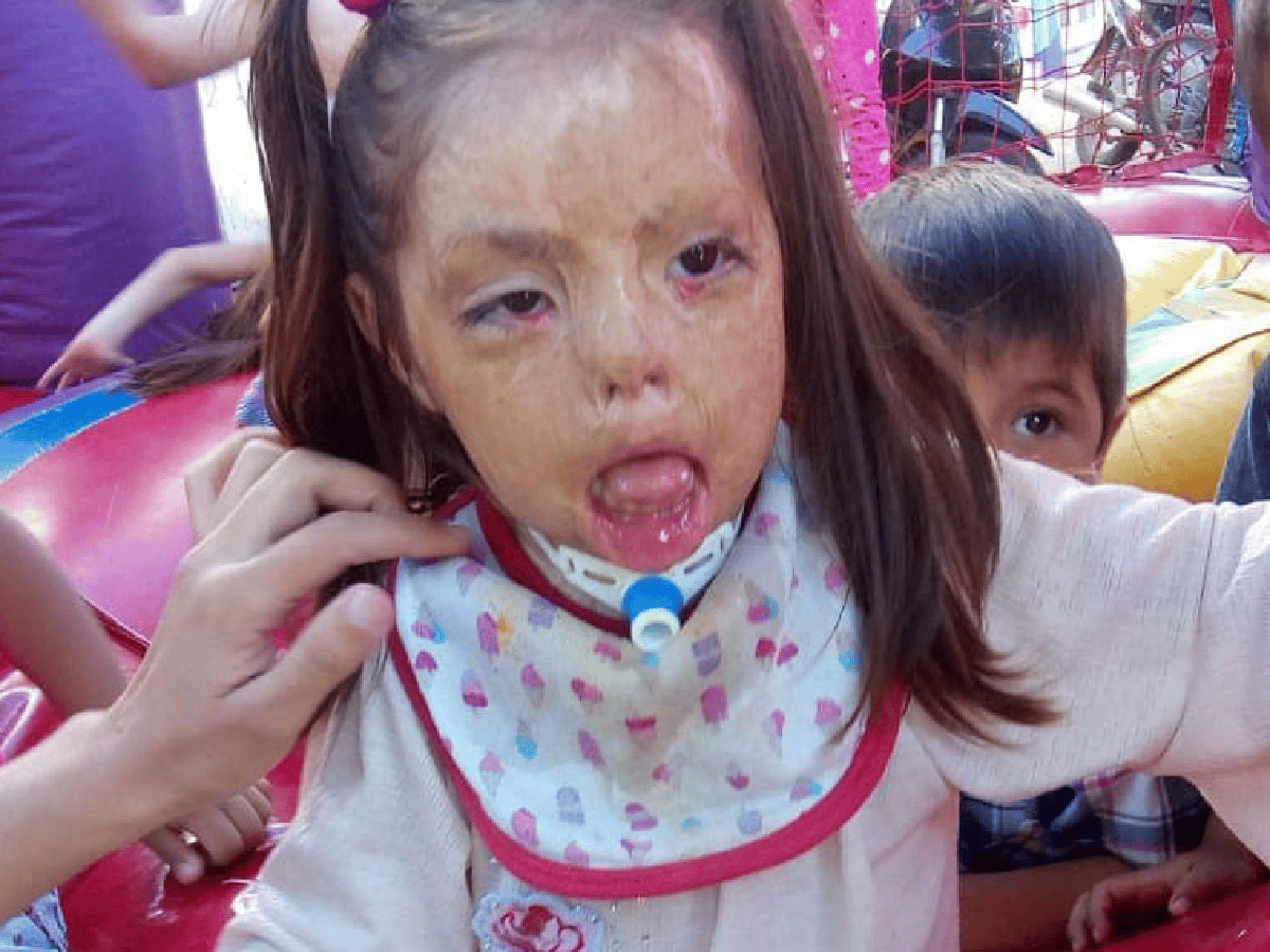 Piden ayuda para una niña de Morteros que sufrió graves quemaduras y debe operarse 