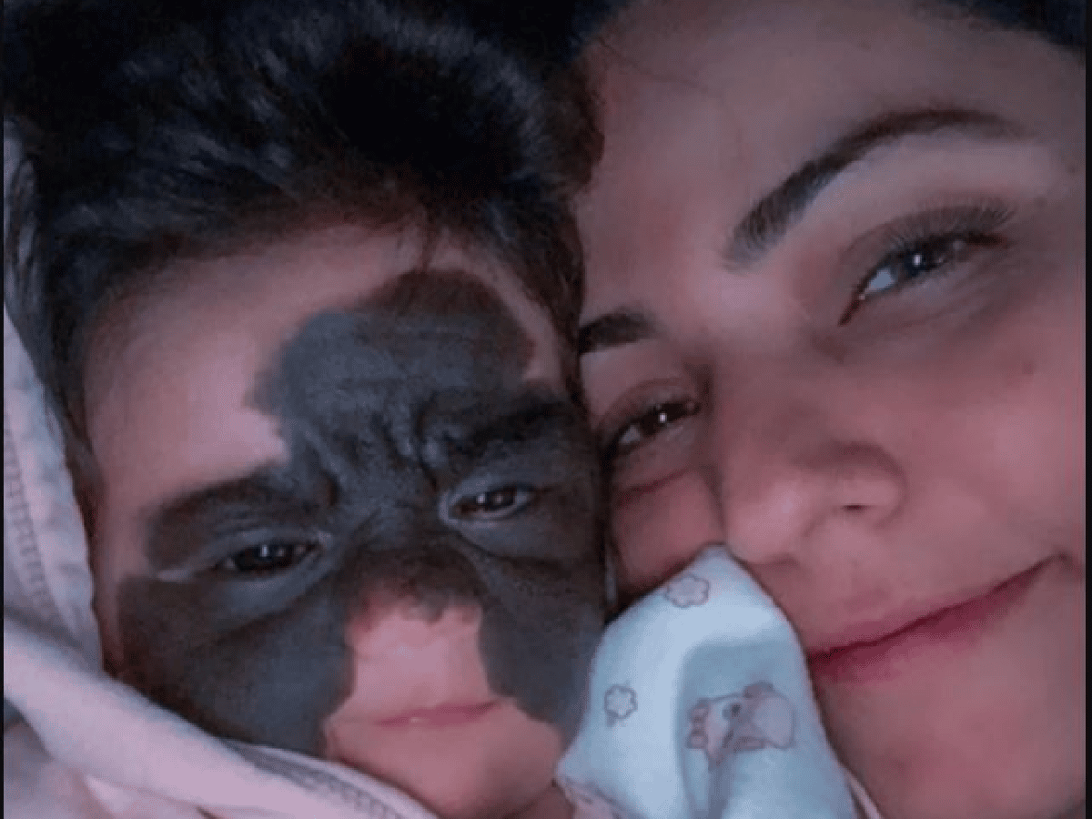 Nació con una "mancha" en su cara y su caso se viralizó en Instagram