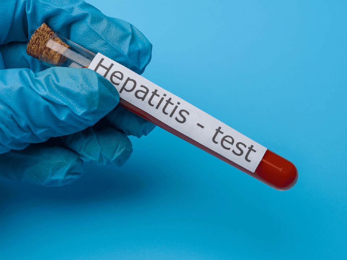 Hepatitis: recomiendan realizarse el test de la enfermedad que afecta a unas 300 mil personas en el país