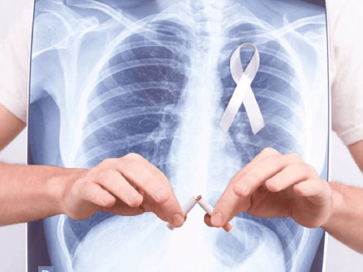 Disminuye la mortalidad  por cáncer de pulmón en la Argentina 