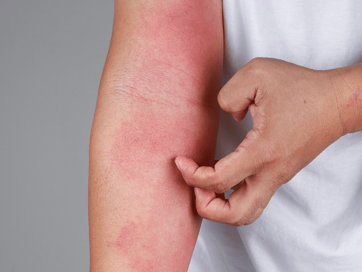 Consejos prácticos para tratar la dermatitis atópica
