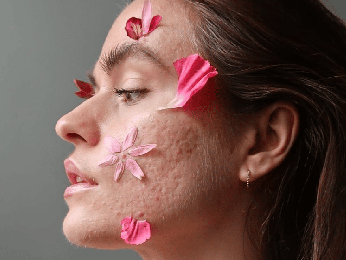 Skin Positivity: la tendencia que  promulga la aceptación de la piel 