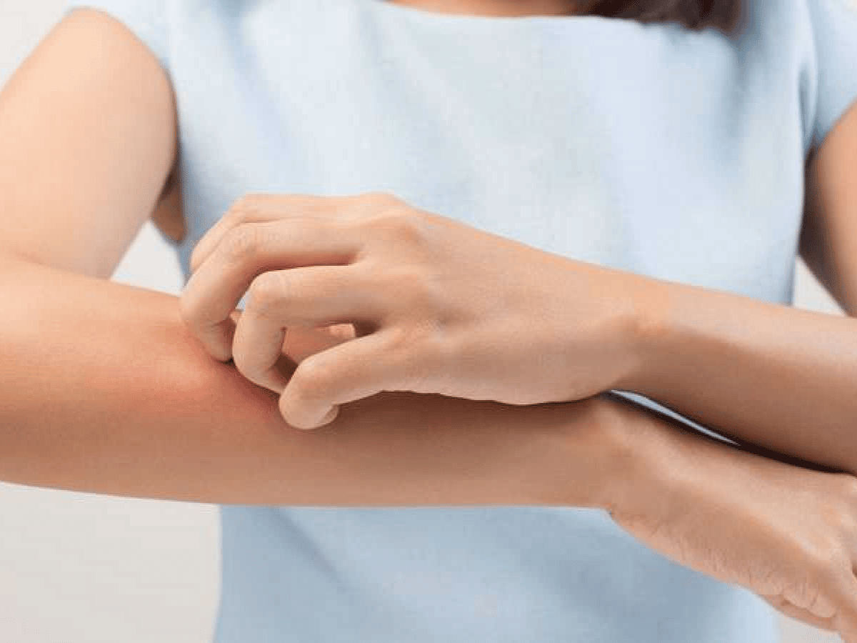 Recomiendan controles preventivos para detectar la dermatitis atópica