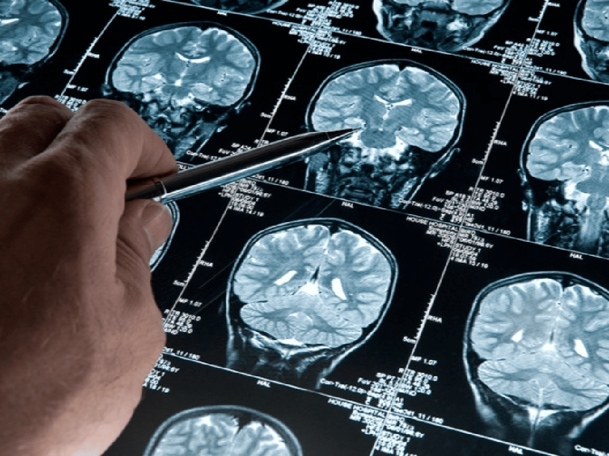 El Alzheimer puede ser detectado 20 años antes que aparezcan síntomas 
