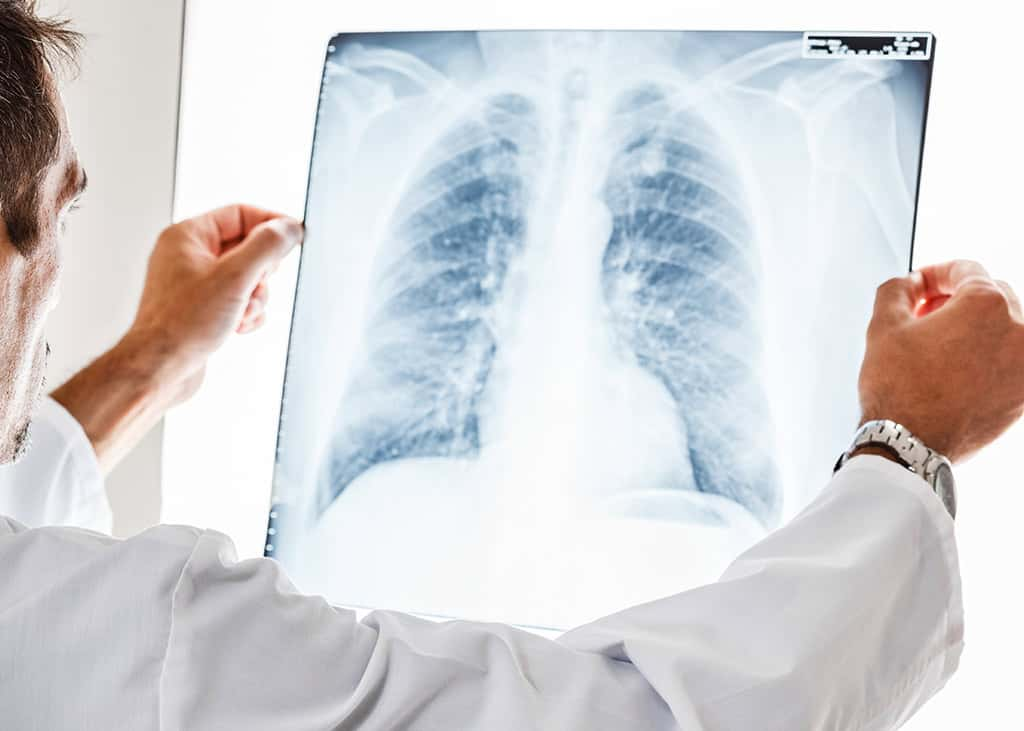 Nódulos pulmonares: ¿qué son y por qué pueden ser cancerosos? – La Voz ...