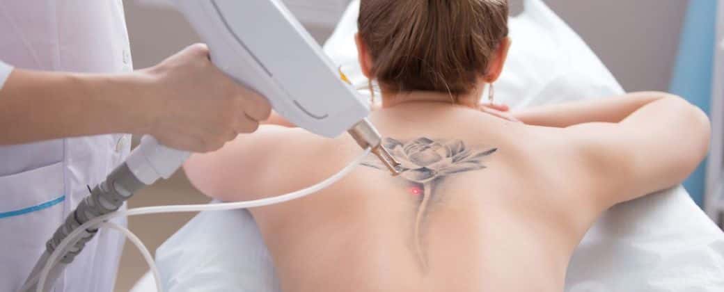 Para eliminar los tatuajes el procedimiento elegido es el tratamiento con láser